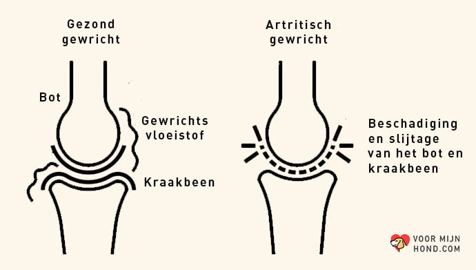 gezond gewricht en artritisch gewricht